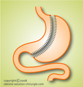 Sleeve gastrectomie