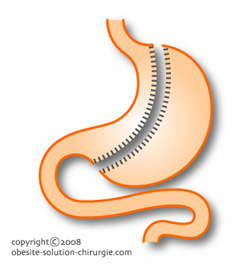 Schème du mode d'action de l'intervention Sleeve gastrectomie