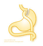 bypass gastrique