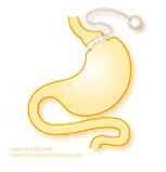 gastroplastie