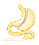 sleeve gastrectomie